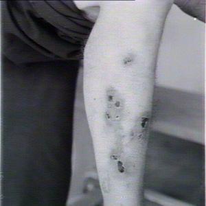 Diseased man's leg: Arsenic poisoning